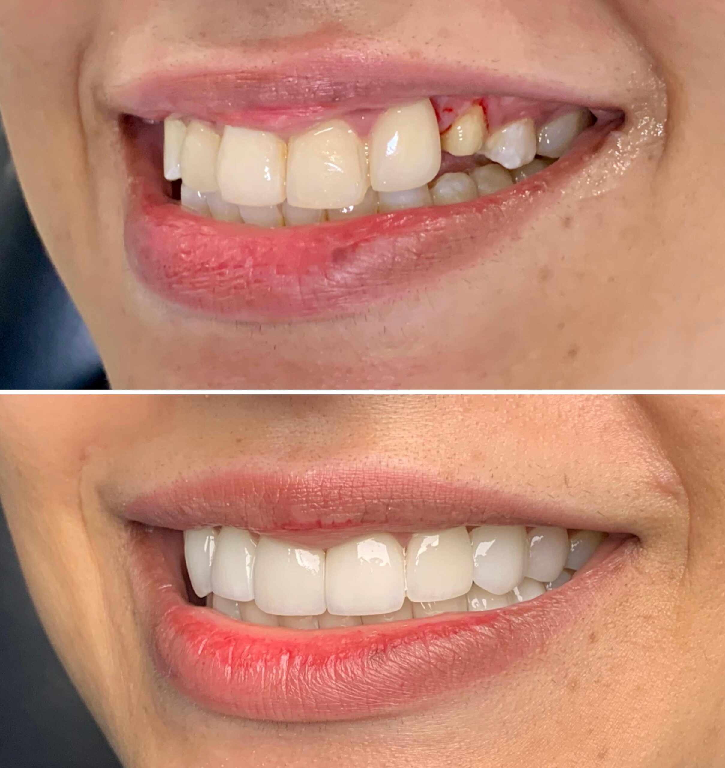 Celebrity Smile Makeover Results