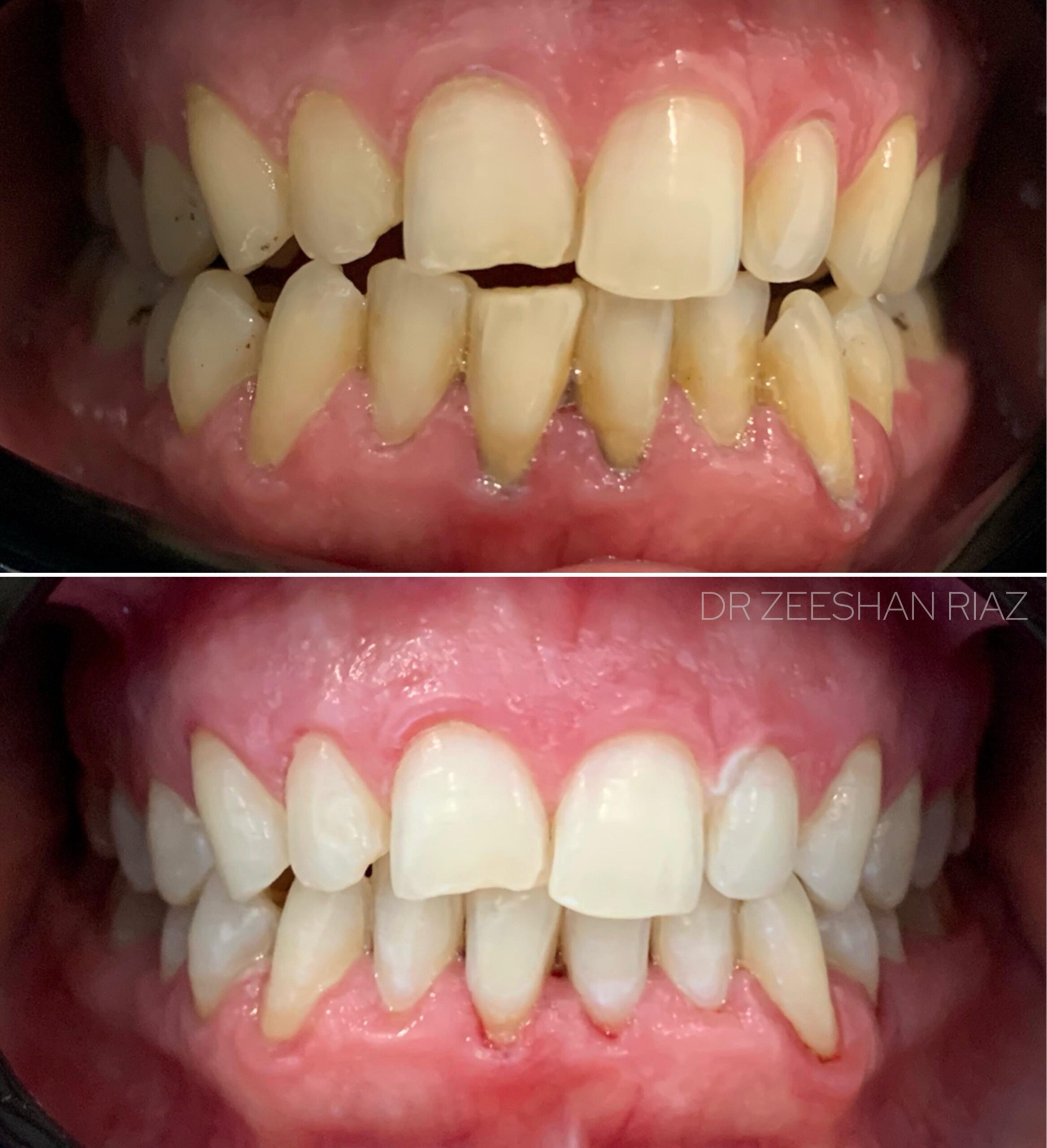 Professional Teeth Whitening Results