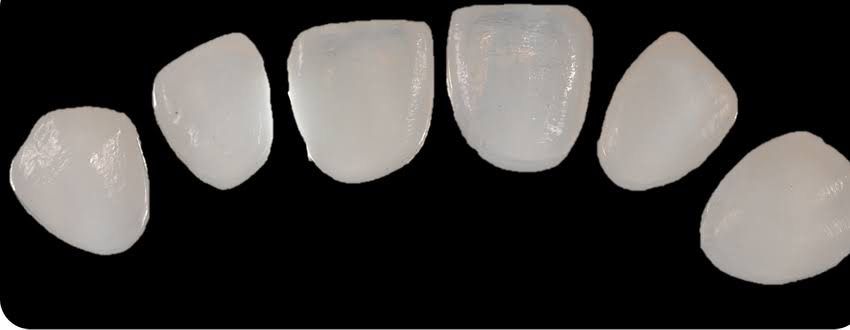 Luxury Veneer Treatment