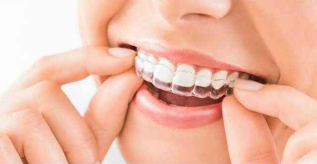 Clear Aligners