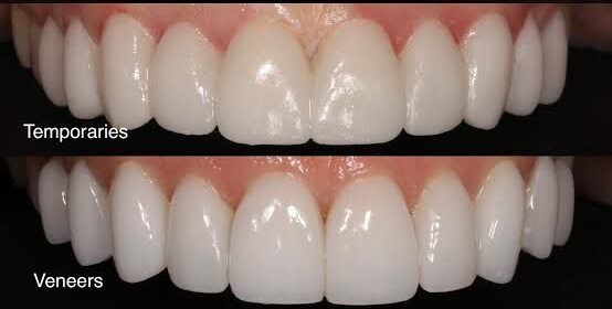 Temporary Veneers