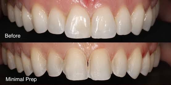 Minimal Tooth Preparation
