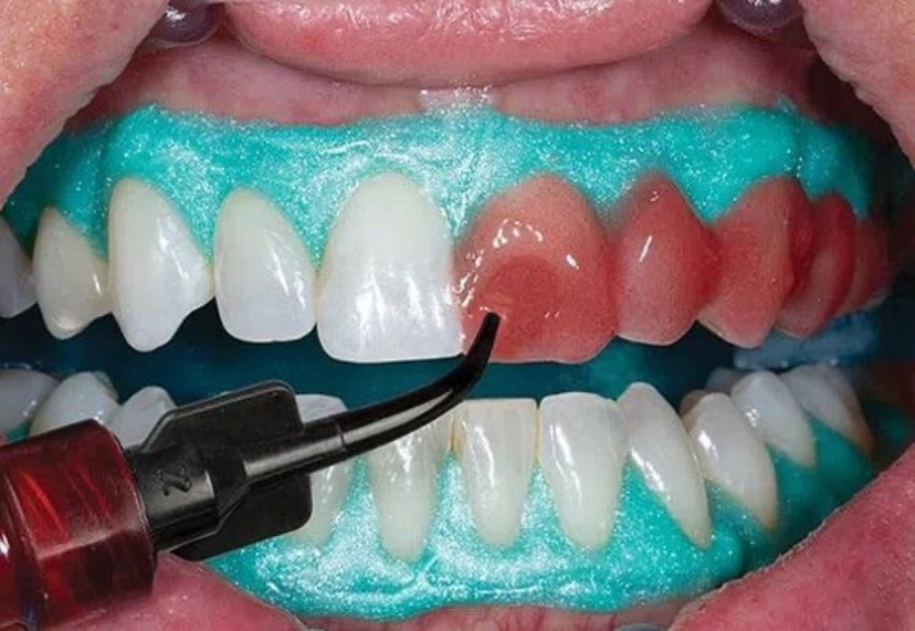 Treatment Preparation