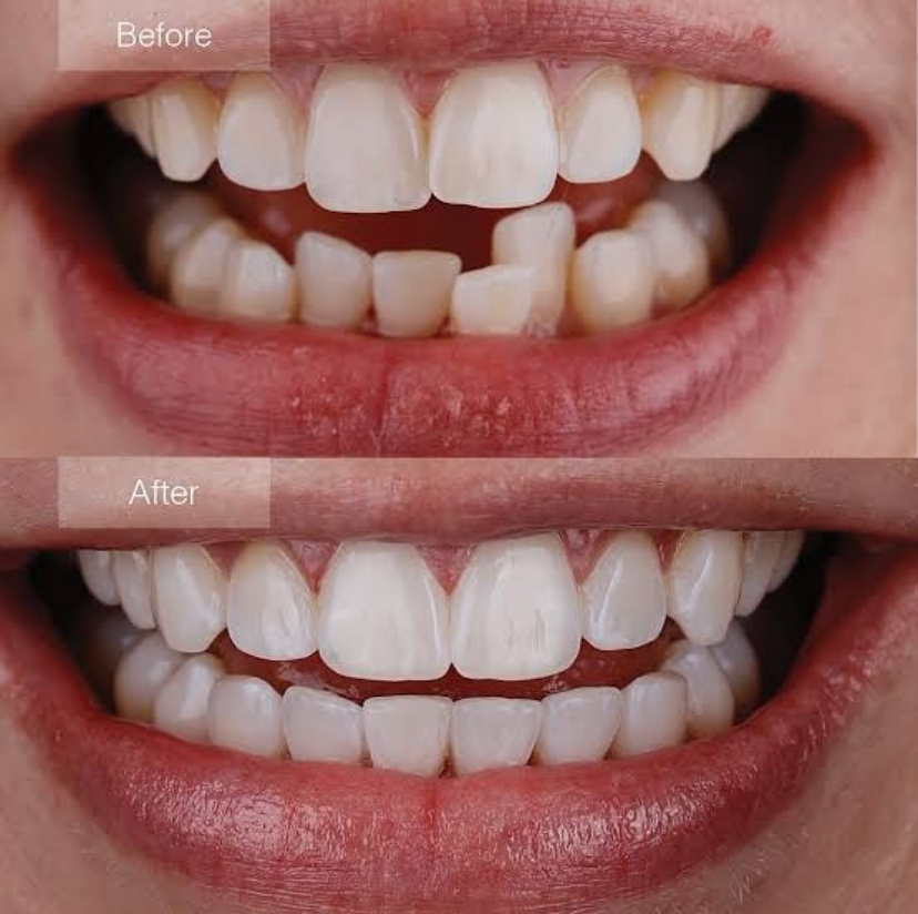 Clear Aligners Treatment Results