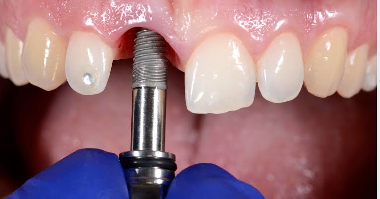 Implant Planning