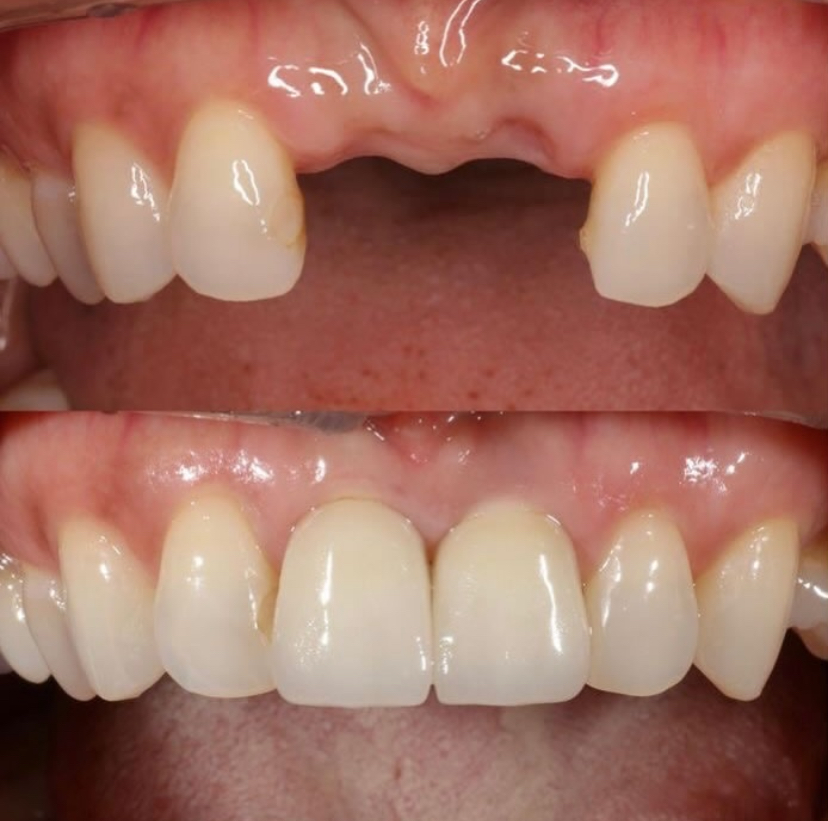 Dental Implant Results